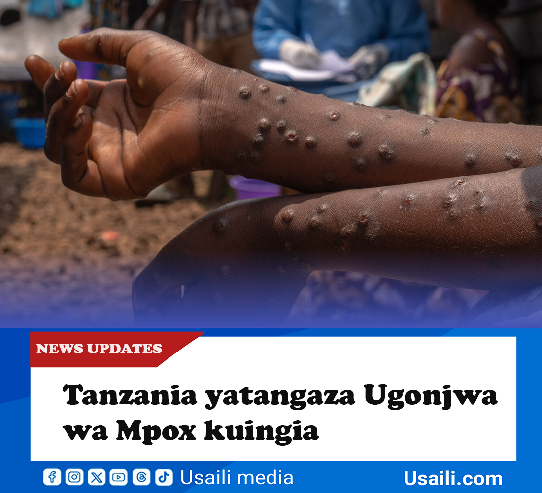 Tanzania yatangaza Ugonjwa wa Mpox kuingia